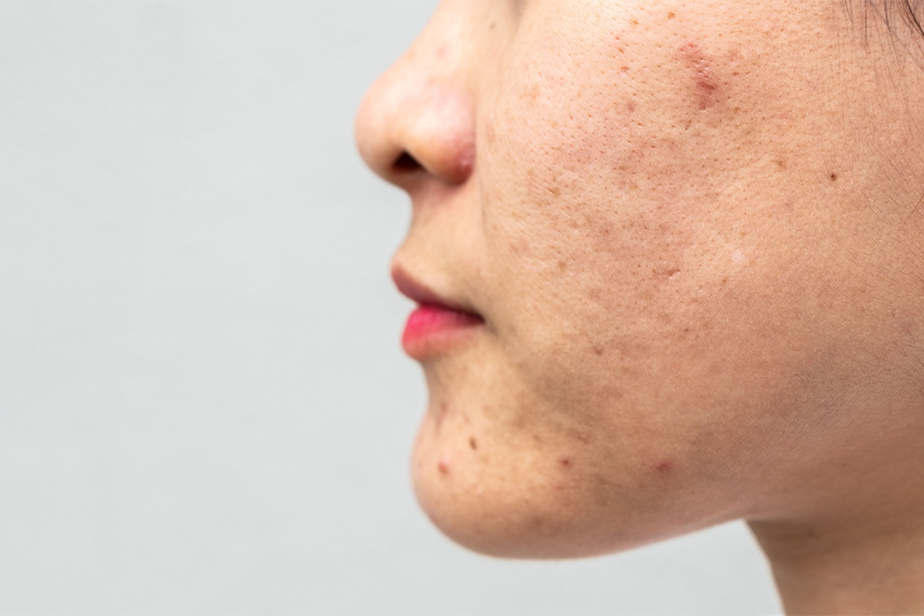 How to prevent clogged pores all summer long.