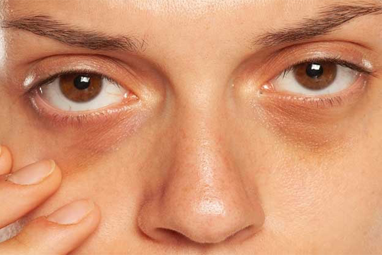 How to get rid of dark circles under the eyes