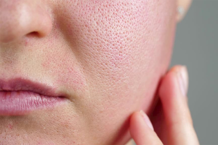 How to prevent clogged pores all summer long.